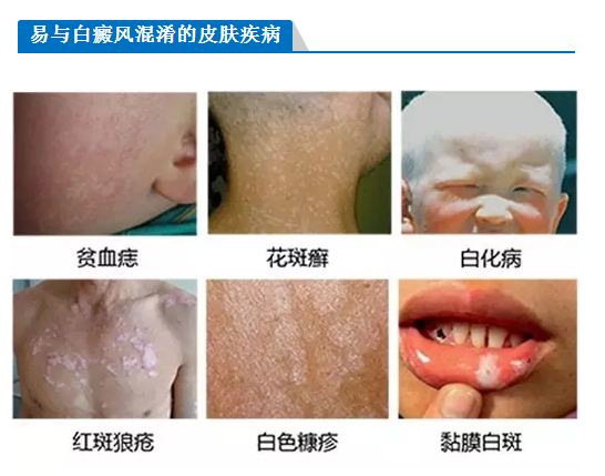 易与白癜混淆的疾病.png
